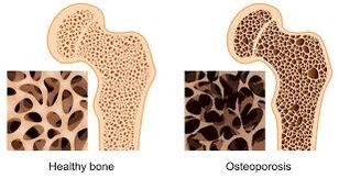 Knochenosteoporose